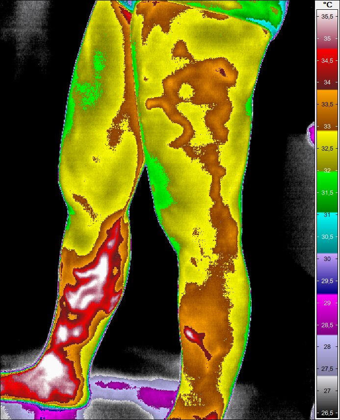 Wärmebildaufnahme „Phlebologie“ von Ingenieurbüro Müller Thermografie und Leckortung